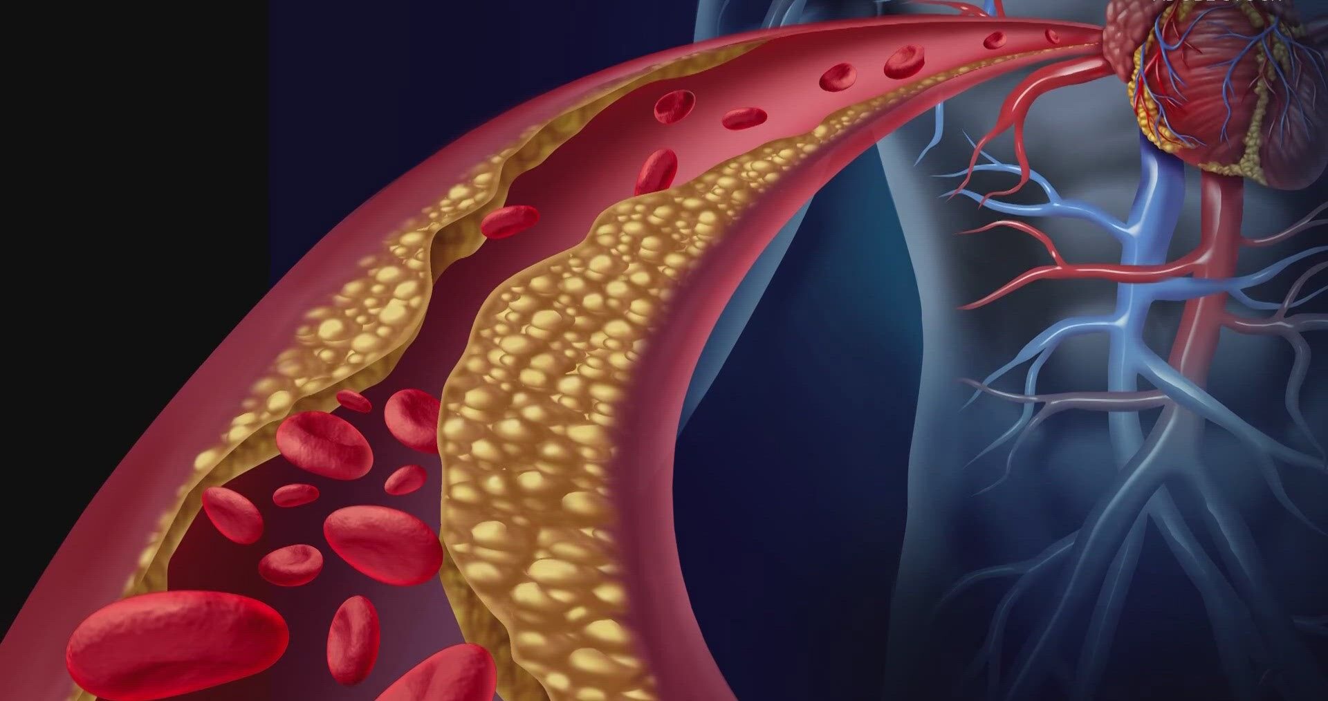 Understanding HDL Cholesterol: Why Is It Low and What It Means for Your Health